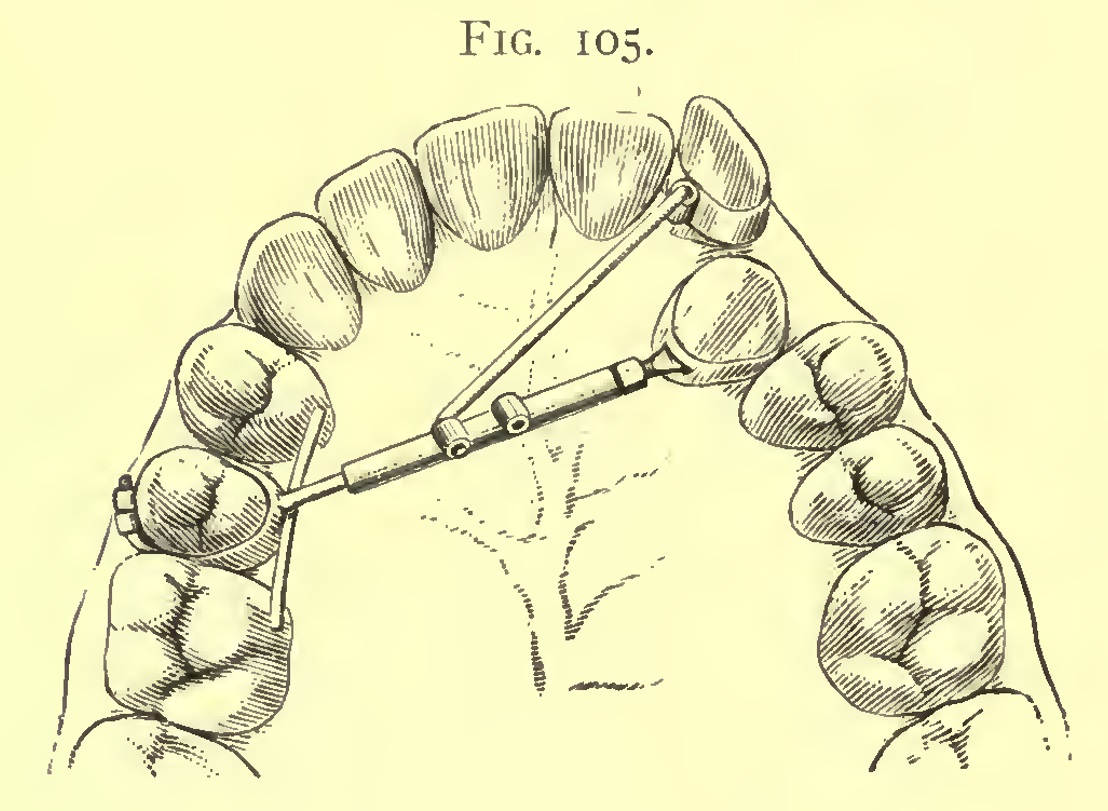 1898_Angle_Fig.105
