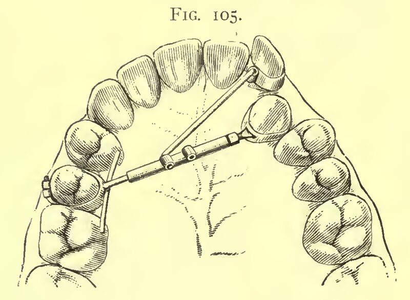 1898_Angle_Fig.105